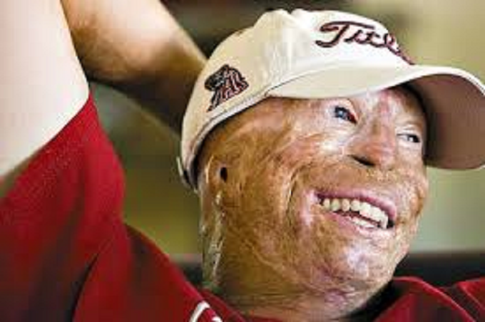 Forrestal burn victim