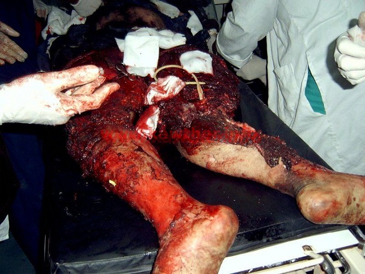 real-bomb-body-parts-probably