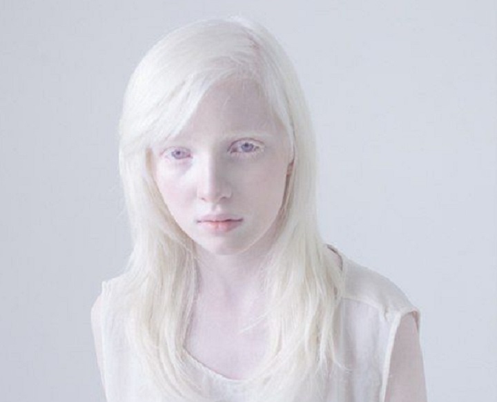 very-albino-girl-720-crop