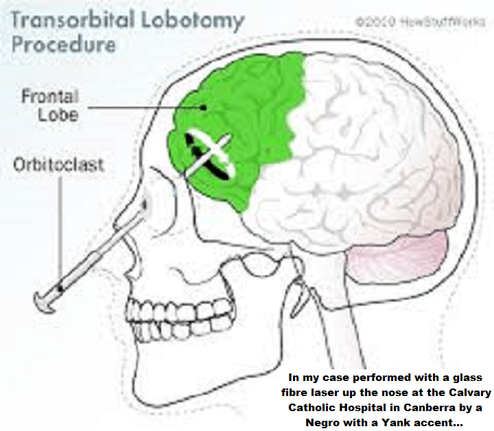 lobotomy-negro-cnut-with-a-yank-accent